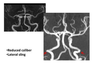 • Defined as that portion of the ICA located
within the cavernous sinus.
Cavernous ICA
 