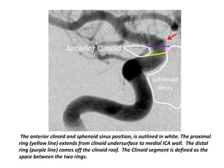 Posterior communicating artery
•Arises – posterior aspect of
intradural ICA just below
anterior choroidal artery
•Course –...