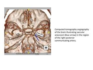 A1 (horizontal): origin from
the ICA to the anterior
communicating artery
(ACOM)
 
