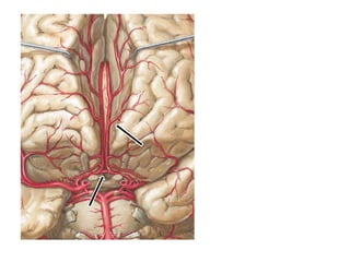 CT study of brain shows infarct involving left
para sagittal frontal lobe. Area of
involvement corresponds to left ACA ter...