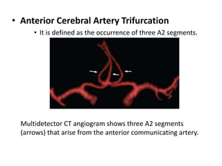 Accessory middle cerebral artery. Multidetector
CT angiogram shows the main middle cerebral
artery (arrowhead) with a smal...