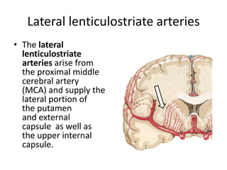FLAIR image showing
ischemic infarct in left
medulla.
Lateral Medullary
Syndrome
 