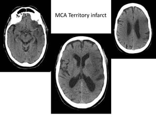 Posterior
inferior
cerebellar
artery
• Segments
• anterior medullary segment
– Front of medulla
• lateral medullary segmen...