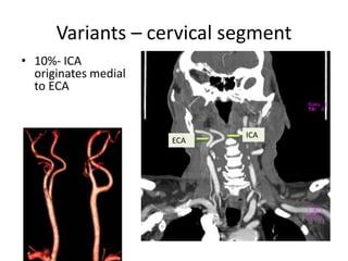 • Anomalous ECA branches arises from cervical
ICA
– The ascending pharyngeal artery occasionally
takes off from the proxim...