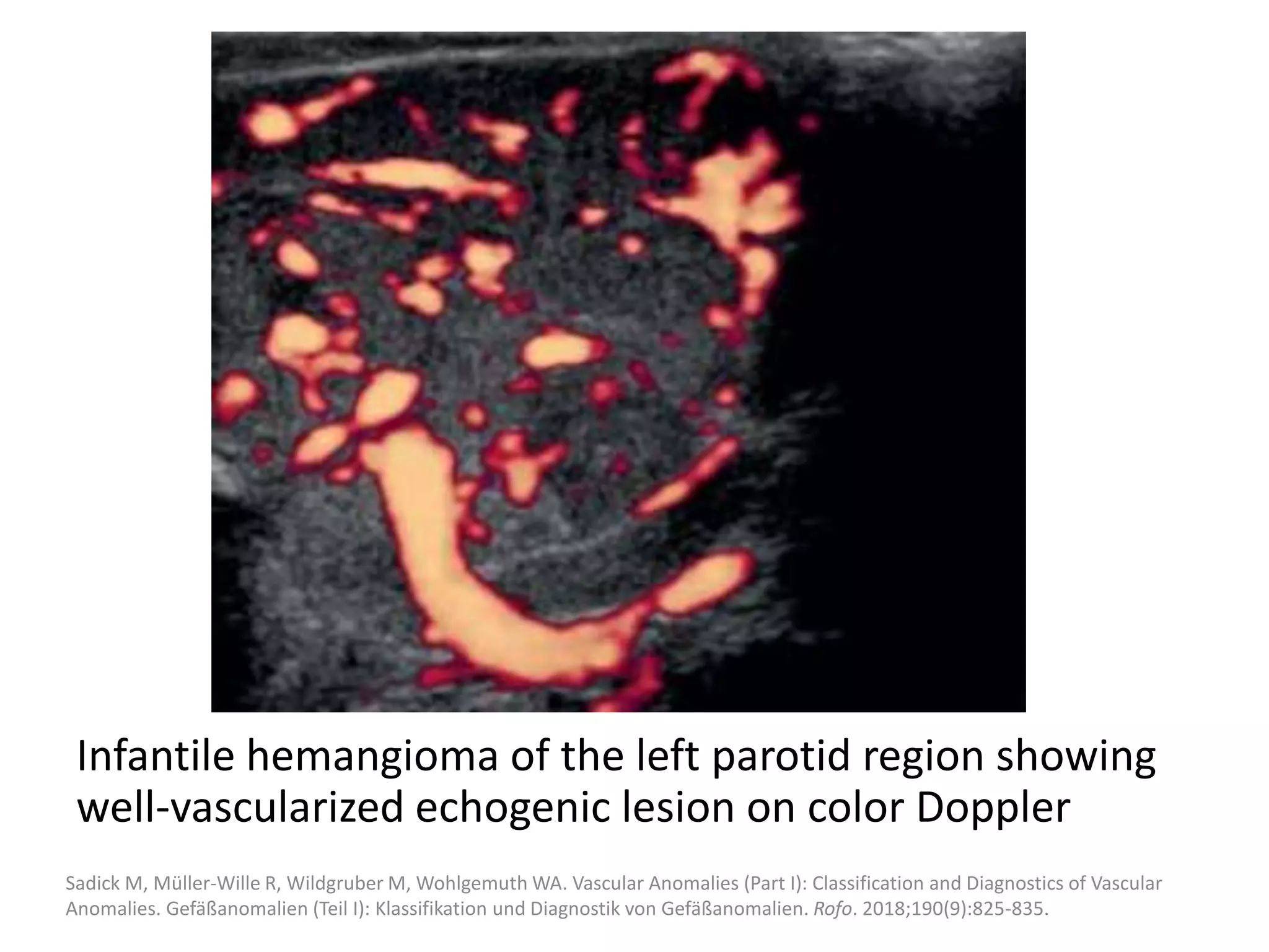 Vascular anomalies.pptx