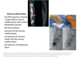 Venous malformation
(a) STIR sequence showed
a hyperintense venous
malformation with central
phleboliths (arrow)
(b) Percutaneous
puncture of the venous
malformation.
(c) Injection of contrast
media into the venous
malformation
(d) Injection of Polidocanol
foam.
Müller-Wille R, Wildgruber M, Sadick M, Wohlgemuth WA. Vascular Anomalies (Part II): Interventional Therapy of Peripheral Vascular
Malformations [published online ahead of print, 2018 Feb 7]. Gefäßanomalien (Teil II): Interventionelle Therapie von peripheren
Gefäßmalformationen [published online ahead of print, 2018 Feb 7]. Rofo. 2018;10.1055/s-0044-101266
 