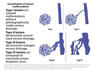 Classification of venous
malformations
Type I lesions are
isolated
malformations
without
phlebographically
visible venous
drainage.
Type II lesions
demonstrate normal-
sized venous drainage.
Type III lesions
demonstrate enlarged
venous drainage.
Type IV lesions are
composed of
essentially ectatic
dysplastic veins.
Müller-Wille R, Wildgruber M, Sadick M, Wohlgemuth WA. Vascular Anomalies (Part II): Interventional Therapy of Peripheral Vascular
Malformations [published online ahead of print, 2018 Feb 7]. Gefäßanomalien (Teil II): Interventionelle Therapie von peripheren
Gefäßmalformationen [published online ahead of print, 2018 Feb 7]. Rofo. 2018;10.1055/s-0044-101266
 