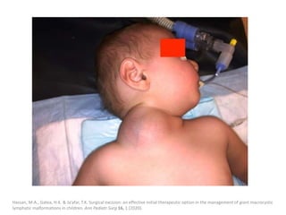 Hassan, M.A., Gatea, H.K. & Ja’afar, T.K. Surgical excision: an effective initial therapeutic option in the management of giant macrocystic
lymphatic malformations in children. Ann Pediatr Surg 16, 1 (2020).
 