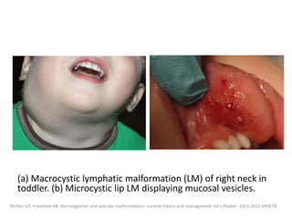 (a) Macrocystic lymphatic malformation (LM) of right neck in
toddler. (b) Microcystic lip LM displaying mucosal vesicles.
Richter GT, Friedman AB. Hemangiomas and vascular malformations: current theory and management. Int J Pediatr. 2012;2012:645678.
 