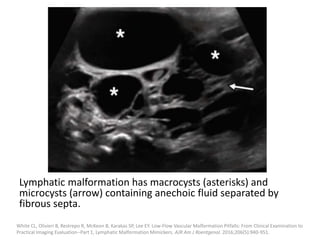 Lymphatic malformation has macrocysts (asterisks) and
microcysts (arrow) containing anechoic fluid separated by
fibrous septa.
White CL, Olivieri B, Restrepo R, McKeon B, Karakas SP, Lee EY. Low-Flow Vascular Malformation Pitfalls: From Clinical Examination to
Practical Imaging Evaluation--Part 1, Lymphatic Malformation Mimickers. AJR Am J Roentgenol. 2016;206(5):940-951.
 