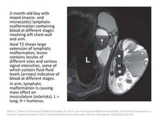 3-month-old boy with
mixed (macro- and
microcystic) lymphatic
malformation containing
blood at different stages
involving left chest wall
and arm.
Axial T2 shows large
extension of lymphatic
malformation, lesion
contains locules of
different sizes and various
signal intensities, some of
which contain fluid-fluid
levels (arrows) indicative of
blood at different stages.
In arm, lymphatic
malformation is causing
mass effect on
musculature (asterisks). L =
lung, H = humerus.
White CL, Olivieri B, Restrepo R, McKeon B, Karakas SP, Lee EY. Low-Flow Vascular Malformation Pitfalls: From Clinical Examination to
Practical Imaging Evaluation--Part 1, Lymphatic Malformation Mimickers. AJR Am J Roentgenol. 2016;206(5):940-951.
 