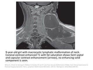 9-year-old girl with macrocystic lymphatic malformation of neck.
Coronal contrast-enhanced T1 with fat saturation shows faint septal
and capsular contrast enhancement (arrows), no enhancing solid
component is seen.
White CL, Olivieri B, Restrepo R, McKeon B, Karakas SP, Lee EY. Low-Flow Vascular Malformation Pitfalls: From Clinical Examination to
Practical Imaging Evaluation--Part 1, Lymphatic Malformation Mimickers. AJR Am J Roentgenol. 2016;206(5):940-951.
 