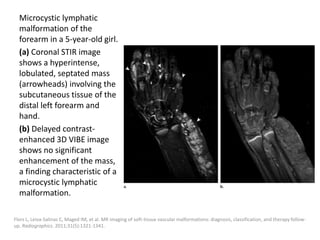 Microcystic lymphatic
malformation of the
forearm in a 5-year-old girl.
(a) Coronal STIR image
shows a hyperintense,
lobulated, septated mass
(arrowheads) involving the
subcutaneous tissue of the
distal left forearm and
hand.
(b) Delayed contrast-
enhanced 3D VIBE image
shows no significant
enhancement of the mass,
a finding characteristic of a
microcystic lymphatic
malformation.
Flors L, Leiva-Salinas C, Maged IM, et al. MR imaging of soft-tissue vascular malformations: diagnosis, classification, and therapy follow-
up. Radiographics. 2011;31(5):1321-1341.
 