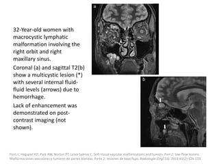32-Year-old women with
macrocystic lymphatic
malformation involving the
right orbit and right
maxillary sinus.
Coronal (a) and sagittal T2(b)
show a multicystic lesion (*)
with several internal fluid-
fluid levels (arrows) due to
hemorrhage.
Lack of enhancement was
demonstrated on post-
contrast imaging (not
shown).
Flors L, Hagspiel KD, Park AW, Norton PT, Leiva-Salinas C. Soft-tissue vascular malformations and tumors. Part 2: low-flow lesions.
Malformaciones vasculares y tumores de partes blandas. Parte 2: lesiones de bajo flujo. Radiologia (Engl Ed). 2019;61(2):124-133.
 