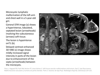 Microcystic lymphatic
malformation of the left arm
and chest wall in a 5-year-old
girl.
Coronal STIR image (a) shows
a hyperintense, lobulated,
septated lesion (arrowheads)
involving the subcutaneous
(arrows) soft tissue.
The lesion is hypointense
onT1 (b).
Delayed contrast-enhanced
3D VIBE (c) image shows
mildly increased signal
intensity in parts of the lesion
due to enhancement of the
septa (arrowheads) between
the microcysts.
Flors L, Hagspiel KD, Park AW, Norton PT, Leiva-Salinas C. Soft-tissue vascular malformations and tumors. Part 2: low-flow lesions.
Malformaciones vasculares y tumores de partes blandas. Parte 2: lesiones de bajo flujo. Radiologia (Engl Ed). 2019;61(2):124-133.
 