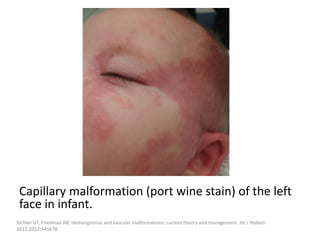 Capillary malformation (port wine stain) of the left
face in infant.
Richter GT, Friedman AB. Hemangiomas and vascular malformations: current theory and management. Int J Pediatr.
2012;2012:645678.
 