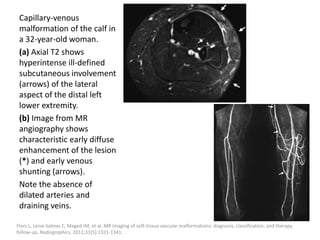 Capillary-venous
malformation of the calf in
a 32-year-old woman.
(a) Axial T2 shows
hyperintense ill-defined
subcutaneous involvement
(arrows) of the lateral
aspect of the distal left
lower extremity.
(b) Image from MR
angiography shows
characteristic early diffuse
enhancement of the lesion
(*) and early venous
shunting (arrows).
Note the absence of
dilated arteries and
draining veins.
Flors L, Leiva-Salinas C, Maged IM, et al. MR imaging of soft-tissue vascular malformations: diagnosis, classification, and therapy
follow-up. Radiographics. 2011;31(5):1321-1341.
 