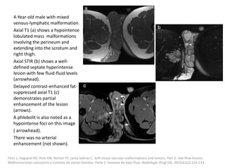 4-Year-old male with mixed
venous-lymphatic malformation.
Axial T1 (a) shows a hypointense
lobulated mass malformations
involving the perineum and
extending into the scrotum and
right thigh.
Axial STIR (b) shows a well-
defined septate hyperintense
lesion with few fluid-fluid levels
(arrowhead).
Delayed contrast-enhanced fat-
suppressed axial T1 (c)
demonstrates partial
enhancement of the lesion
(arrows).
A phlebolit is also noted as a
hypointense foci on this image
( arrowhead).
There was no arterial
enhancement (not shown).
Flors L, Hagspiel KD, Park AW, Norton PT, Leiva-Salinas C. Soft-tissue vascular malformations and tumors. Part 2: low-flow lesions.
Malformaciones vasculares y tumores de partes blandas. Parte 2: lesiones de bajo flujo. Radiologia (Engl Ed). 2019;61(2):124-133.
 