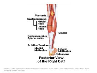 De Crée C (2015) Rupture of the Medial Head of the Gastrocnemius Muscle in Late-Career and Former Elite Jūdōka: A Case Report.
Ann Sports Med Res 2(5): 1032.
 