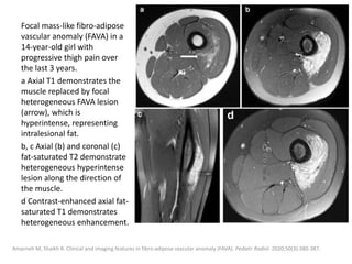 Focal mass-like fibro-adipose
vascular anomaly (FAVA) in a
14-year-old girl with
progressive thigh pain over
the last 3 years.
a Axial T1 demonstrates the
muscle replaced by focal
heterogeneous FAVA lesion
(arrow), which is
hyperintense, representing
intralesional fat.
b, c Axial (b) and coronal (c)
fat-saturated T2 demonstrate
heterogeneous hyperintense
lesion along the direction of
the muscle.
d Contrast-enhanced axial fat-
saturated T1 demonstrates
heterogeneous enhancement.
Amarneh M, Shaikh R. Clinical and imaging features in fibro-adipose vascular anomaly (FAVA). Pediatr Radiol. 2020;50(3):380-387.
 