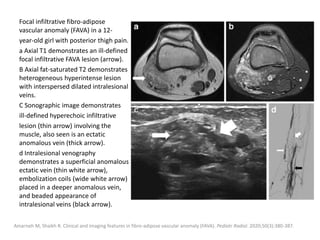Focal infiltrative fibro-adipose
vascular anomaly (FAVA) in a 12-
year-old girl with posterior thigh pain.
a Axial T1 demonstrates an ill-defined
focal infiltrative FAVA lesion (arrow).
B Axial fat-saturated T2 demonstrates
heterogeneous hyperintense lesion
with interspersed dilated intralesional
veins.
C Sonographic image demonstrates
ill-defined hyperechoic infiltrative
lesion (thin arrow) involving the
muscle, also seen is an ectatic
anomalous vein (thick arrow).
d Intralesional venography
demonstrates a superficial anomalous
ectatic vein (thin white arrow),
embolization coils (wide white arrow)
placed in a deeper anomalous vein,
and beaded appearance of
intralesional veins (black arrow).
Amarneh M, Shaikh R. Clinical and imaging features in fibro-adipose vascular anomaly (FAVA). Pediatr Radiol. 2020;50(3):380-387.
 