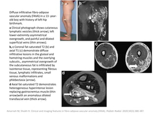 Diffuse infiltrative fibro-adipose
vascular anomaly (FAVA) in a 13- year-
old boy with history of left hip
birthmark.
a Clinical photograph shows cutaneous
lymphatic vesicles (thick arrow), left
lower-extremity asymmetrical
overgrowth, and painful and dilated
superficial veins (thin arrows).
b, c Coronal fat-saturated T2 (b) and
axial T1 (c) demonstrate diffuse
infiltrative lesions in the gluteal and
hamstring muscles and the overlying
subcutis., asymmetrical overgrowth of
the subcutaneous fat is infiltrated by
isointense tissue, representing fibrous
tissue, lymphatic infiltrates, small
venous malformations and
phlebectasia (arrow).
d Axial fat-saturated T2 demonstrates
heterogeneous hyperintense lesion
replacing gastrocnemius muscle (thin
arrow)with an anomalous dilated
transfascial vein (thick arrow).
Amarneh M, Shaikh R. Clinical and imaging features in fibro-adipose vascular anomaly (FAVA). Pediatr Radiol. 2020;50(3):380-387.
 