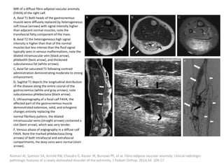 MRI of a diffuse fibro-adipose vascular anomaly
(FAVA) of the right calf.
A, Axial T1 Both heads of the gastrocnemius
muscle were diffusely replaced by heterogeneous
soft tissue (arrows) with signal intensity higher
than adjacent normal muscles, note the
transfascial fatty component of the mass.
B, Axial T2 the heterogeneous high signal
intensity is higher than that of the normal
muscles but less intense than the fluid signal
typically seen in venous malformations, note the
dilated intramuscular vein (black arrow),
phlebolith (bent arrow), and thickened
subcutaneous fat (white arrows).
C, Axial fat-saturated T1 following contrast
administration demonstrating moderate to strong
enhancement.
D, Sagittal T1 depicts the longitudinal distribution
of the disease along the entire course of the
gastrocnemius (white and gray arrows), note
subcutaneous phlebectasia (black arrow).
E, Ultrasonography of a focal calf FAVA, the
affected part of the gastrocnemius muscle
demonstrated extensive, solid, and echogenic
changes entirely replacing the
normal fibrillary pattern, the dilated
intramuscular veins (straight arrows) contained a
clot (bent arrow), which was very tender.
F, Venous phase of angiography in a diffuse calf
FAVA. Note the marked phlebectasia (long
arrows) of both intrafascial and extrafascial
compartments, the deep veins were normal (short
arrows).
Alomari AI, Spencer SA, Arnold RW, Chaudry G, Kasser JR, Burrows PE, et al. Fibro-adipose vascular anomaly: clinical-radiologic-
pathologic features of a newly delineated disorder of the extremity. J Pediatr Orthop. 2014;34: 109-17.
 