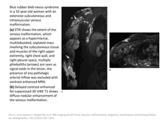 Blue rubber bleb nevus syndrome
in a 32-year-old woman with an
extensive subcutaneous and
intramuscular venous
malformation.
(a) STIR shows the extent of the
venous malformation, which
appears as a hyperintense,
multilobulated, septated mass
involving the subcutaneous tissue
and muscles of the right upper
extremity, right chest wall, and
right pleural space, multiple
phleboliths (arrows) are seen as
signal voids in the lesion, the
presence of any pathologic
arterial inflow was excluded with
contrast-enhanced MRA.
(b) Delayed contrast-enhanced
fat-suppressed 3D VIBE T1 shows
diffuse nodular enhancement of
the venous malformation.
Flors L, Leiva-Salinas C, Maged IM, et al. MR imaging of soft-tissue vascular malformations: diagnosis, classification, and therapy follow-
up. Radiographics. 2011;31(5):1321-1341.
 