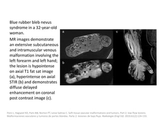 Blue rubber bleb nevus
syndrome in a 32-year-old
woman.
MR images demonstrate
an extensive subcutaneous
and intramuscular venous
malformation involving the
left forearm and left hand;
the lesion is hypointense
on axial T1 fat sat image
(a), hyperintense on axial
STIR (b) and demonstrates
diffuse delayed
enhancement on coronal
post contrast image (c).
Flors L, Hagspiel KD, Park AW, Norton PT, Leiva-Salinas C. Soft-tissue vascular malformations and tumors. Part 2: low-flow lesions.
Malformaciones vasculares y tumores de partes blandas. Parte 2: lesiones de bajo flujo. Radiologia (Engl Ed). 2019;61(2):124-133.
 