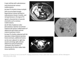 2-year-old boy with subcutaneous
and intramuscular venous
malformations.
(a) Axial T2 of pelvis shows multiple
well-circumscribed strongly
hyperintense masses (arrows) in
subcutaneous tissues, muscles, and
retroperitoneum, this type of T2
signal is characteristic of vascular
anomalies such as venous
malformations.
(b) AP DSA of abdomen after
percutaneous injection of contrast
material into venous malformation of
abdominal wall shows contrast
material pooling in lesion.
(c) Axial T2 of pelvis obtained with fat
saturation shows bilateral parailiac
lesions (arrows), additional lesions
can be seen adjacent to right iliac
vessels and along right anterior
abdominal wall (arrowheads)
,symmetric iliac location is
characteristic for blue rubber bleb
nevus syndrome.
Kassarjian A, Fishman SJ, Fox VL, Burrows PE. Imaging characteristics of blue rubber bleb nevus syndrome. AJR Am J Roentgenol.
2003;181(4):1041-1048.
 