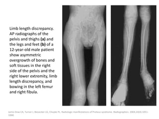 Limb length discrepancy.
AP radiographs of the
pelvis and thighs (a) and
the legs and feet (b) of a
12-year-old male patient
show asymmetric
overgrowth of bones and
soft tissues in the right
side of the pelvis and the
right lower extremity, limb
length discrepancy, and
bowing in the left femur
and right fibula.
Jamis-Dow CA, Turner J, Biesecker LG, Choyke PL. Radiologic manifestations of Proteus syndrome. Radiographics. 2004;24(4):1051-
1068.
 