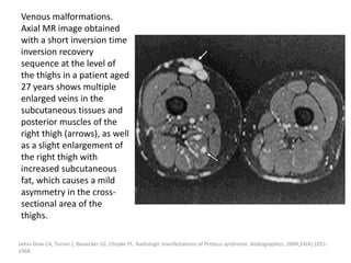 Venous malformations.
Axial MR image obtained
with a short inversion time
inversion recovery
sequence at the level of
the thighs in a patient aged
27 years shows multiple
enlarged veins in the
subcutaneous tissues and
posterior muscles of the
right thigh (arrows), as well
as a slight enlargement of
the right thigh with
increased subcutaneous
fat, which causes a mild
asymmetry in the cross-
sectional area of the
thighs.
Jamis-Dow CA, Turner J, Biesecker LG, Choyke PL. Radiologic manifestations of Proteus syndrome. Radiographics. 2004;24(4):1051-
1068.
 