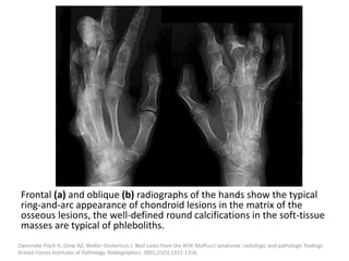 Frontal (a) and oblique (b) radiographs of the hands show the typical
ring-and-arc appearance of chondroid lesions in the matrix of the
osseous lesions, the well-defined round calcifications in the soft-tissue
masses are typical of phleboliths.
Zwenneke Flach H, Ginai AZ, Wolter Oosterhuis J. Best cases from the AFIP. Maffucci syndrome: radiologic and pathologic findings.
Armed Forces Institutes of Pathology. Radiographics. 2001;21(5):1311-1316.
 