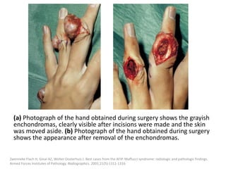 (a) Photograph of the hand obtained during surgery shows the grayish
enchondromas, clearly visible after incisions were made and the skin
was moved aside. (b) Photograph of the hand obtained during surgery
shows the appearance after removal of the enchondromas.
Zwenneke Flach H, Ginai AZ, Wolter Oosterhuis J. Best cases from the AFIP. Maffucci syndrome: radiologic and pathologic findings.
Armed Forces Institutes of Pathology. Radiographics. 2001;21(5):1311-1316.
 