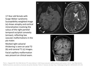 17-Year-old female with
Surge-Weber syndrome.
Susceptibility weighted image
(a) shows atrophy and cortical
mineralization involving the
sulcus of the right parietal-
temporal occipital convexity
(arrows), reflecting low
vascular malformations in the
pia mater.
Marked right calvarial
thickening is seen on axial T2
(b) and coronal T1 (c) images.
Facial capillary malformation
was present on clinical exam.
Flors L, Hagspiel KD, Park AW, Norton PT, Leiva-Salinas C. Soft-tissue vascular malformations and tumors. Part 2: low-flow lesions.
Malformaciones vasculares y tumores de partes blandas. Parte 2: lesiones de bajo flujo. Radiologia (Engl Ed). 2019;61(2):124-133.
 