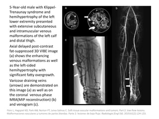 5-Year-old male with Klippel-
Trenaunay syndrome and
hemihypertrophy of the left
lower extremity presented
with extensive subcutaneous
and intramuscular venous
malformations of the left calf
and distal thigh.
Axial delayed post-contrast
fat-suppressed 3D VIBE image
(a) shows the enhancing
venous malformations as well
as the left-sided
hemihypertrophy with
significant fatty overgrowth.
Varicose draining veins
(arrows) are demonstrated on
this image (a) as well as on
the coronal venous phase
MRA(MIP reconstruction) (b)
and venogram (c).
Flors L, Hagspiel KD, Park AW, Norton PT, Leiva-Salinas C. Soft-tissue vascular malformations and tumors. Part 2: low-flow lesions.
Malformaciones vasculares y tumores de partes blandas. Parte 2: lesiones de bajo flujo. Radiologia (Engl Ed). 2019;61(2):124-133.
 