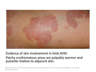Evidence of skin involvement in limb AVM.
Patchy erythematous areas are palpably warmer and
pulsatile relative to adjacent skin.
Richter GT, Friedman AB. Hemangiomas and vascular malformations: current theory and management. Int J Pediatr.
2012;2012:645678.
 