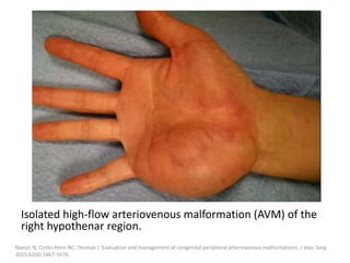 Isolated high-flow arteriovenous malformation (AVM) of the
right hypothenar region.
Nassiri N, Cirillo-Penn NC, Thomas J. Evaluation and management of congenital peripheral arteriovenous malformations. J Vasc Surg.
2015;62(6):1667-1676.
 