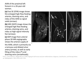 AVM of the proximal left
forearm in a 26-year-old
woman.
(a) Fast SE (STIR) image shows
the enlarged high-flow feeding
arteries, draining veins, and
nidus of the AVM as signal
voids (arrows).
(b) GRE (SSFP) image shows the
enlarged high-flow feeding
arteries, draining veins, and
nidus as high-signal-intensity
foci (arrows).
(c) MIP image from arterial
phase 3D MR angiography
shows the arterial supply of
the AVM, which is primarily via
a tortuous and dilated ulnar
artery (arrow), as well as early
filling of the nidus (*) and
draining veins (arrowheads).
Flors L, Leiva-Salinas C, Maged IM, et al. MR imaging of soft-tissue vascular malformations: diagnosis, classification, and therapy follow-
up. Radiographics. 2011;31(5):1321-1341.
 
