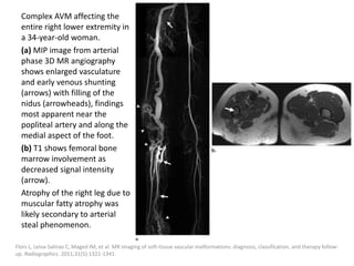 Complex AVM affecting the
entire right lower extremity in
a 34-year-old woman.
(a) MIP image from arterial
phase 3D MR angiography
shows enlarged vasculature
and early venous shunting
(arrows) with filling of the
nidus (arrowheads), findings
most apparent near the
popliteal artery and along the
medial aspect of the foot.
(b) T1 shows femoral bone
marrow involvement as
decreased signal intensity
(arrow).
Atrophy of the right leg due to
muscular fatty atrophy was
likely secondary to arterial
steal phenomenon.
Flors L, Leiva-Salinas C, Maged IM, et al. MR imaging of soft-tissue vascular malformations: diagnosis, classification, and therapy follow-
up. Radiographics. 2011;31(5):1321-1341.
 