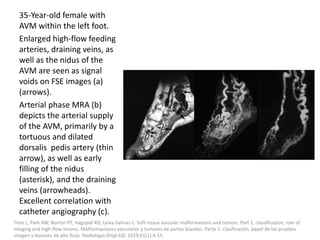 35-Year-old female with
AVM within the left foot.
Enlarged high-flow feeding
arteries, draining veins, as
well as the nidus of the
AVM are seen as signal
voids on FSE images (a)
(arrows).
Arterial phase MRA (b)
depicts the arterial supply
of the AVM, primarily by a
tortuous and dilated
dorsalis pedis artery (thin
arrow), as well as early
filling of the nidus
(asterisk), and the draining
veins (arrowheads).
Excellent correlation with
catheter angiography (c).
Flors L, Park AW, Norton PT, Hagspiel KD, Leiva-Salinas C. Soft-tissue vascular malformations and tumors. Part 1: classification, role of
imaging and high-flow lesions. Malformaciones vasculares y tumores de partes blandas. Parte 1: clasificación, papel de las pruebas
imagen y lesiones de alto flujo. Radiologia (Engl Ed). 2019;61(1):4-15.
 