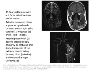 35-Year-old female with
left facial arteriovenous
malformation.
Arteries, veins and nidus
appear as signal voids
(arrows) on fast spin echo
coronal T1-weighted (a)
and STIR (b) images.
Arterial phase MRA (c)
depicts arterial supply
primarily by tortuous and
dilated branches of the
external carotid artery
(arrow), nidus (asterisk)
and venous drainage
(arrowhead).
Flors L, Park AW, Norton PT, Hagspiel KD, Leiva-Salinas C. Soft-tissue vascular malformations and tumors. Part 1: classification, role of
imaging and high-flow lesions. Malformaciones vasculares y tumores de partes blandas. Parte 1: clasificación, papel de las pruebas
imagen y lesiones de alto flujo. Radiologia (Engl Ed). 2019;61(1):4-15.
 