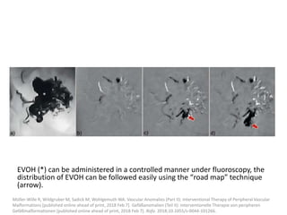 EVOH (*) can be administered in a controlled manner under fluoroscopy, the
distribution of EVOH can be followed easily using the “road map” technique
(arrow).
Müller-Wille R, Wildgruber M, Sadick M, Wohlgemuth WA. Vascular Anomalies (Part II): Interventional Therapy of Peripheral Vascular
Malformations [published online ahead of print, 2018 Feb 7]. Gefäßanomalien (Teil II): Interventionelle Therapie von peripheren
Gefäßmalformationen [published online ahead of print, 2018 Feb 7]. Rofo. 2018;10.1055/s-0044-101266.
 