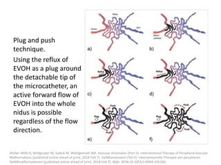 Plug and push
technique.
Using the reflux of
EVOH as a plug around
the detachable tip of
the microcatheter, an
active forward flow of
EVOH into the whole
nidus is possible
regardless of the flow
direction.
Müller-Wille R, Wildgruber M, Sadick M, Wohlgemuth WA. Vascular Anomalies (Part II): Interventional Therapy of Peripheral Vascular
Malformations [published online ahead of print, 2018 Feb 7]. Gefäßanomalien (Teil II): Interventionelle Therapie von peripheren
Gefäßmalformationen [published online ahead of print, 2018 Feb 7]. Rofo. 2018;10.1055/s-0044-101266.
 