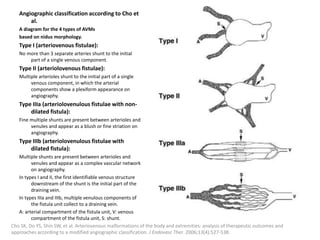 Angiographic classification according to Cho et
al.
A diagram for the 4 types of AVMs
based on nidus morphology.
Type I (arteriovenous fistulae):
No more than 3 separate arteries shunt to the initial
part of a single venous component.
Type II (arteriolovenous fistulae):
Multiple arterioles shunt to the initial part of a single
venous component, in which the arterial
components show a plexiform appearance on
angiography.
Type IIIa (arteriolovenulous fistulae with non-
dilated fistula):
Fine multiple shunts are present between arterioles and
venules and appear as a blush or fine striation on
angiography.
Type IIIb (arteriolovenulous fistulae with
dilated fistula):
Multiple shunts are present between arterioles and
venules and appear as a complex vascular network
on angiography.
In types I and II, the first identifiable venous structure
downstream of the shunt is the initial part of the
draining vein.
In types IIIa and IIIb, multiple venulous components of
the fistula unit collect to a draining vein.
A: arterial compartment of the fistula unit, V: venous
compartment of the fistula unit, S: shunt.
Cho SK, Do YS, Shin SW, et al. Arteriovenous malformations of the body and extremities: analysis of therapeutic outcomes and
approaches according to a modified angiographic classification. J Endovasc Ther. 2006;13(4):527-538.
 
