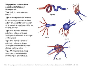 Angiographic classification
according to Yakes and
Baumgartner.
Type I: direct arteriovenous
fistula.
Type II: multiple inflow arteries
into a nidus pattern with direct
artery-arteriolar to vein-venular
structures that might or might not
be aneurysmal.
Type IIIa: multiple arteries-
arterioles into an enlarged
aneurysmal vein with an enlarged
outflow vein.
Type IIIb: multiple arteries-
arterioles into an enlarged
aneurysmal vein with multiple
dilated outflow veins.
Type IV: innumerable micro-
arteriovenous connections
infiltrating an entire tissue.
Yakes W, Baumgartner I. Interventional treatment of arteriovenous malformations. Gefasschirurgie 2014;19(04):325–330
 