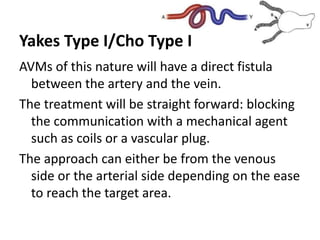 Yakes Type I/Cho Type I
AVMs of this nature will have a direct fistula
between the artery and the vein.
The treatment will be straight forward: blocking
the communication with a mechanical agent
such as coils or a vascular plug.
The approach can either be from the venous
side or the arterial side depending on the ease
to reach the target area.
 