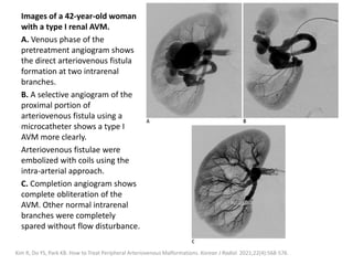 Images of a 42-year-old woman
with a type I renal AVM.
A. Venous phase of the
pretreatment angiogram shows
the direct arteriovenous fistula
formation at two intrarenal
branches.
B. A selective angiogram of the
proximal portion of
arteriovenous fistula using a
microcatheter shows a type I
AVM more clearly.
Arteriovenous fistulae were
embolized with coils using the
intra-arterial approach.
C. Completion angiogram shows
complete obliteration of the
AVM. Other normal intrarenal
branches were completely
spared without flow disturbance.
Kim R, Do YS, Park KB. How to Treat Peripheral Arteriovenous Malformations. Korean J Radiol. 2021;22(4):568-576.
 