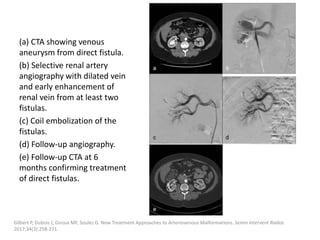 (a) CTA showing venous
aneurysm from direct fistula.
(b) Selective renal artery
angiography with dilated vein
and early enhancement of
renal vein from at least two
fistulas.
(c) Coil embolization of the
fistulas.
(d) Follow-up angiography.
(e) Follow-up CTA at 6
months confirming treatment
of direct fistulas.
Gilbert P, Dubois J, Giroux MF, Soulez G. New Treatment Approaches to Arteriovenous Malformations. Semin Intervent Radiol.
2017;34(3):258-271.
 