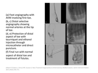 (a) Foot angiography with
AVM involving first toe.
(b, c) Distal selective
angiography showing
normal arteries at the tip
of toe.
(d, e) Protection of distal
aspect of toe with
tourniquet and ethanol
injection through
microcatheter and direct
puncture.
(f) Final run with normal
aspect of distal toe and
treatment of fistulas.
Gilbert P, Dubois J, Giroux MF, Soulez G. New Treatment Approaches to Arteriovenous Malformations. Semin Intervent Radiol.
2017;34(3):258-271.
 